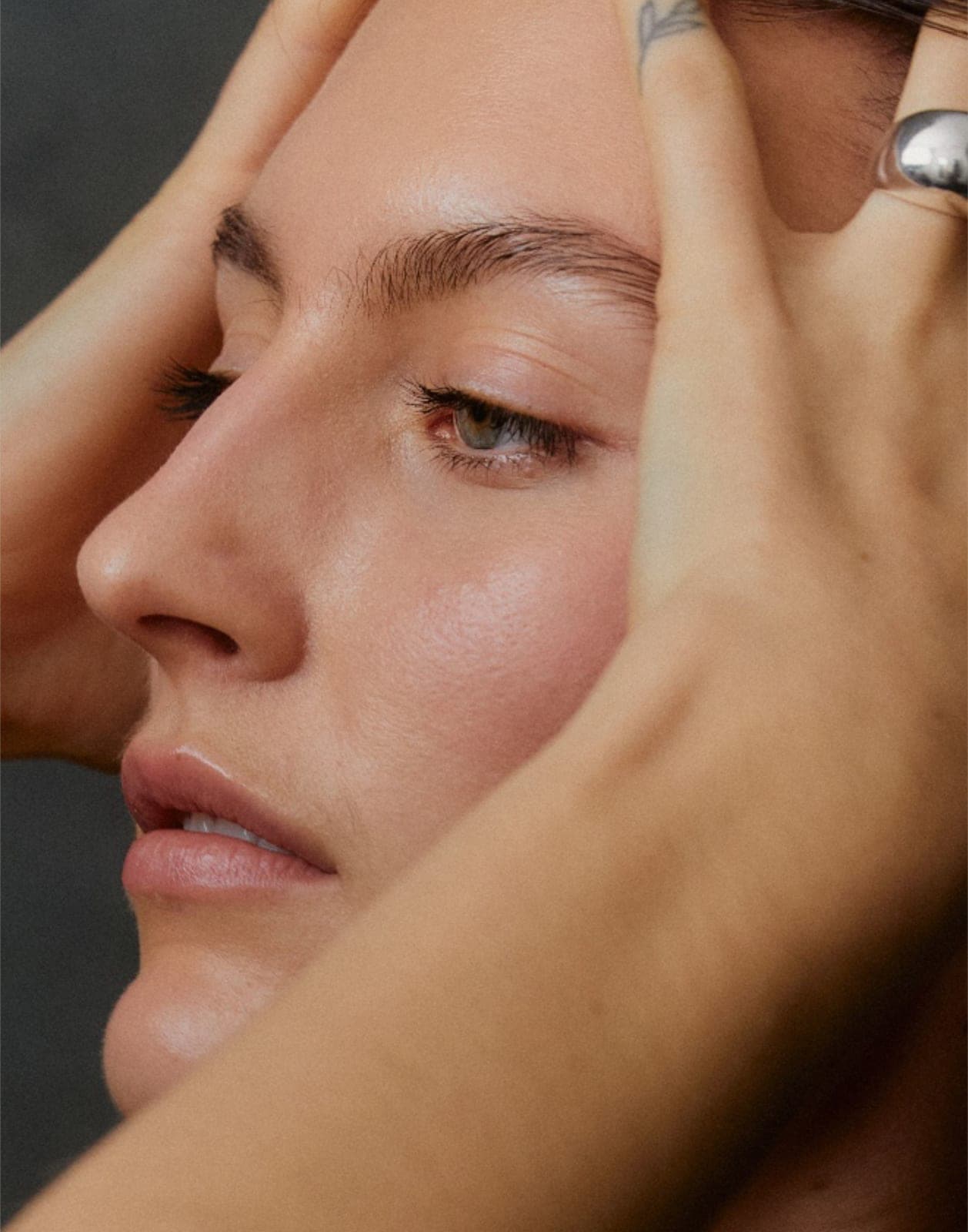 Nodular acne