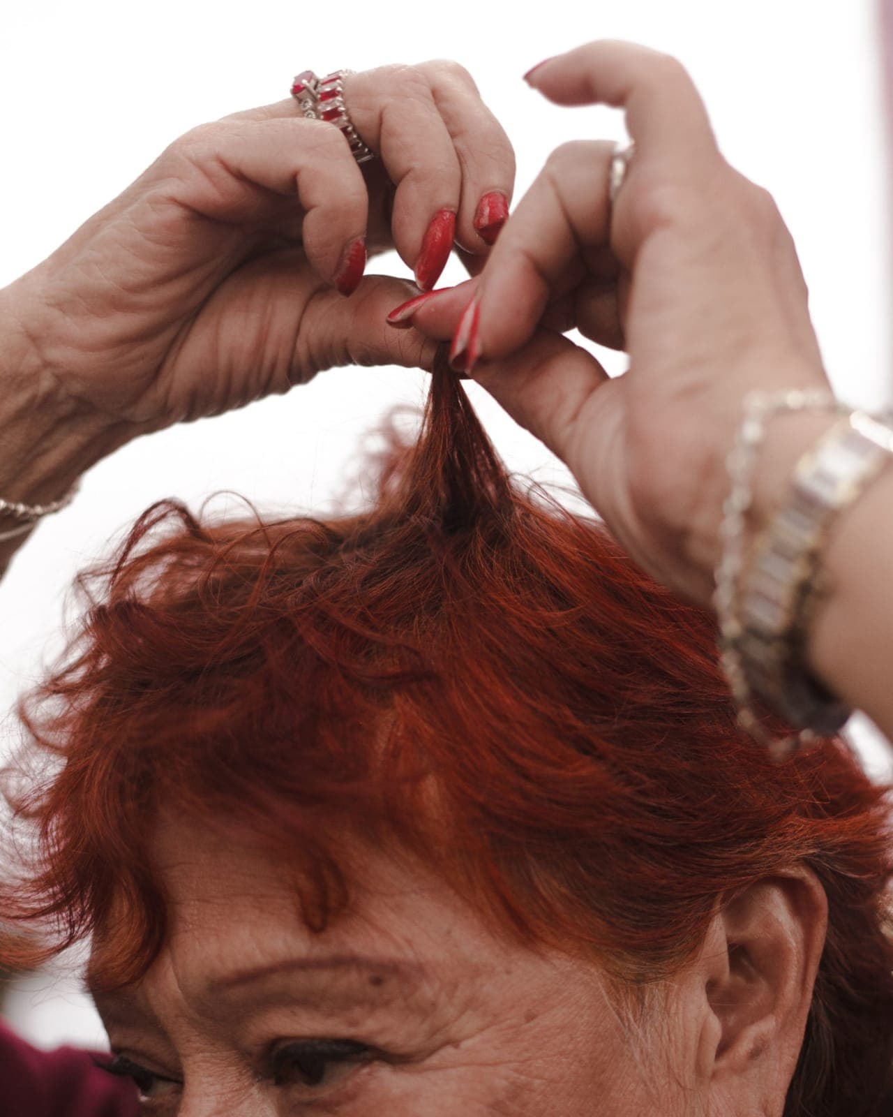 Scalp Psoriasis