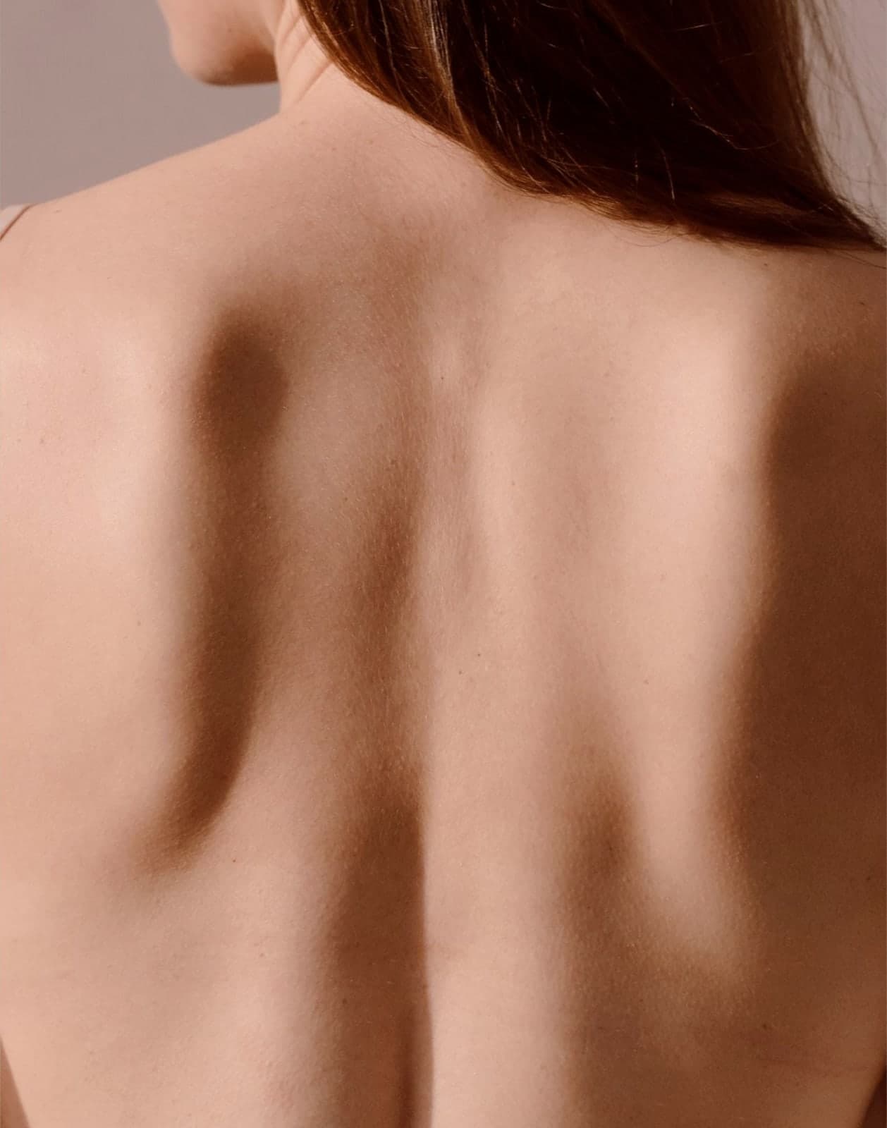Body acne
